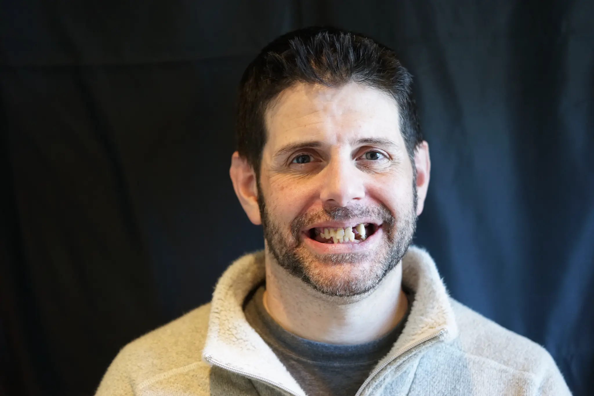 Before All-on-X treatment - missing teeth