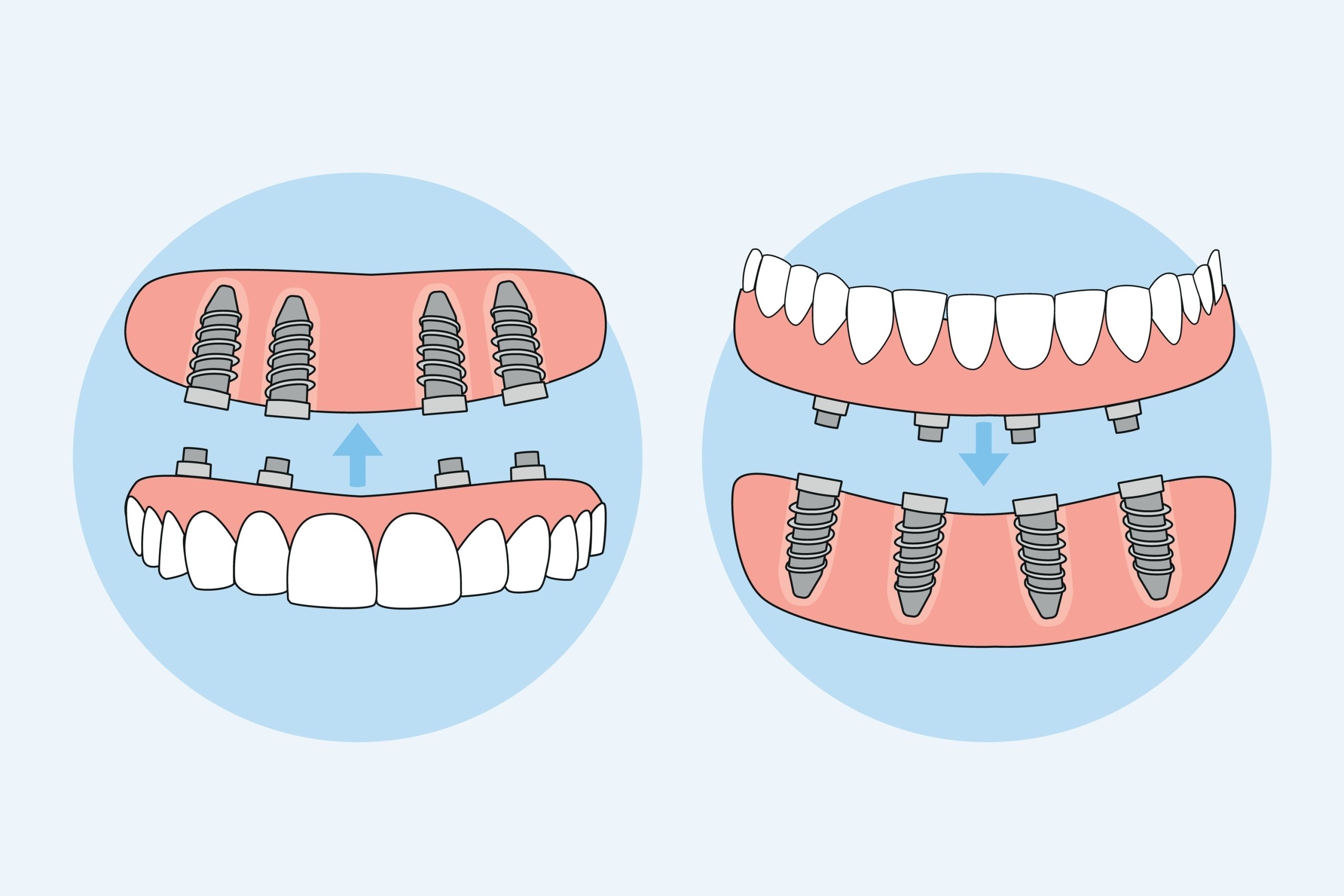 All-on-X dental implants diagram