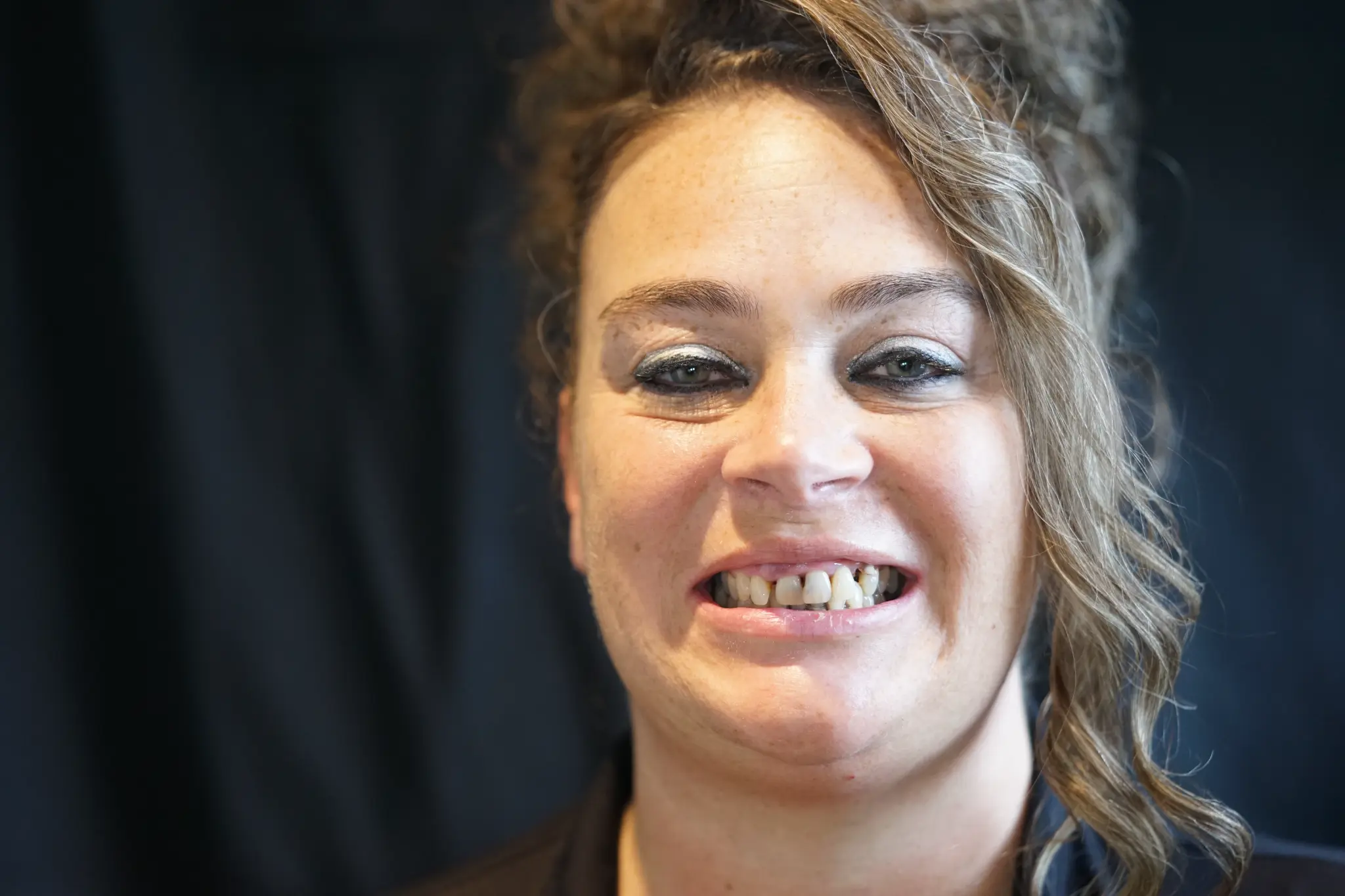 Before All-on-X treatment - damaged and discolored teeth